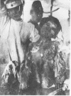 Hiroshima Radiation Victim