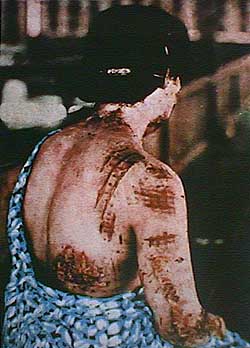 Hiroshima - Nagasaki - Victim